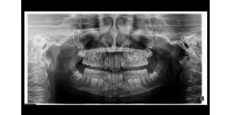 Radiografia Parorâmica Digital